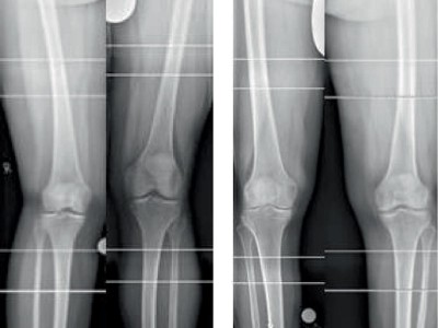 Röntgenaufnahmen von Valgus- und Varusachsen