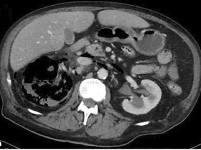 Emphysematöse Pyelonephritis in der kontrastmittelgestützten CT