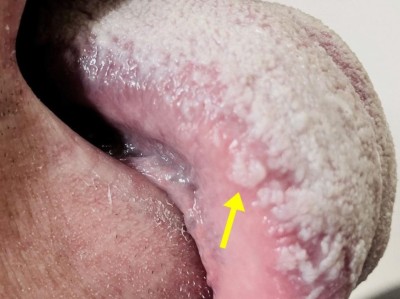 Orale Haarleukoplakie