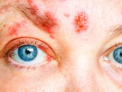 Herpes Zoster im Gesicht