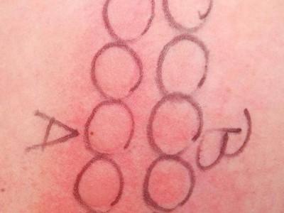 Lichttreppe mit UVAund UVB gluteal