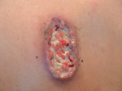 Multilokuläres Pyoderma gangraenosum durch Levamisolgestrecktes Kokain