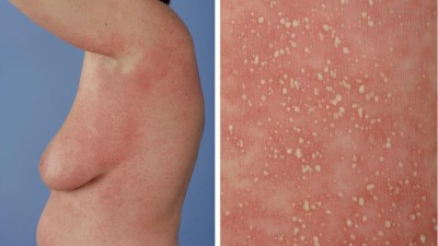  Psoriasis pustulosa