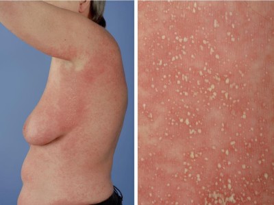  Psoriasis pustulosa