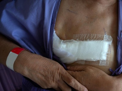 Frau hält sich eine Brustseite nach Mastektomie