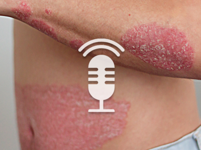 Springer Medizin Podcast - Psoriasis