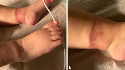 Verätzung durch sogenannte „Essigsöckchen“