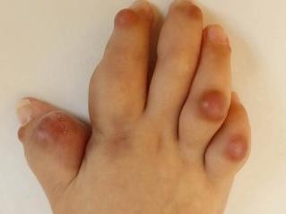 Infantile systemische Hyalinose