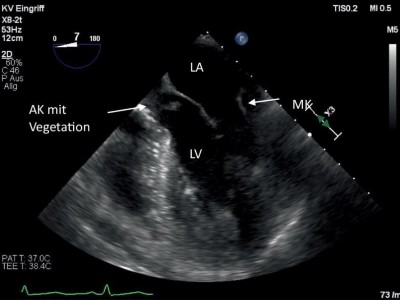 Vegetationen der Herzklappe