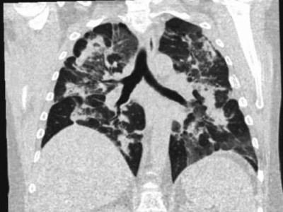 Computertomographie des Thorax