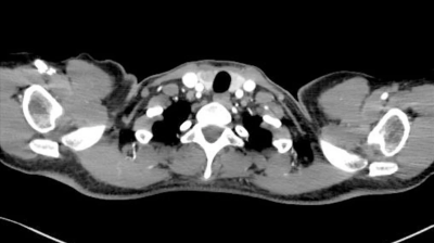 CT images showing hypoechoic lesions in the right lobe of the thyroid gland