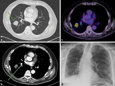 Bildgebung einer rechts pulmonalen Raumforderung der Lunge