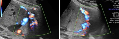 Placenta percreta und praevia