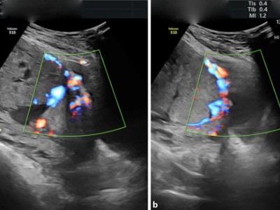 Placenta percreta und praevia