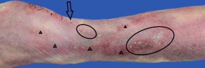 Spuren der Thiopental-Injektion