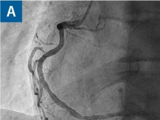 Koronarangiografie der Herzkranzarterien