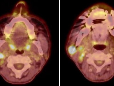 18-FDG-PET-Fusions-CT vom Kopf