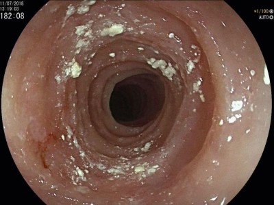 Endoskopischer Aspekt nach Entfernung eines impaktierten Bolus