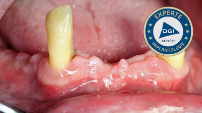 Ansicht Unterkiefer mit Restbezahnung der beiden Zähne 33 und 43