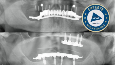 Ansicht zweier OPG Aufnahmen eines Gebisses die übereinanderliegend sind. Im Oberen Bild sind Schlotterkamm im Oberkiefer und Brückenversorgung auf Restbezahnung im Unterkiefer zu sehen. Im unteren Bild sind sowohl im OK als auch im UK auf jeweils 4 Implantaten getragene Versorgungen zu sehen