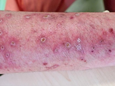 Multiple erythematöse teils hyperkeratotische Plaques