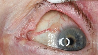 Amelanotic conjunctival malignant melanoma