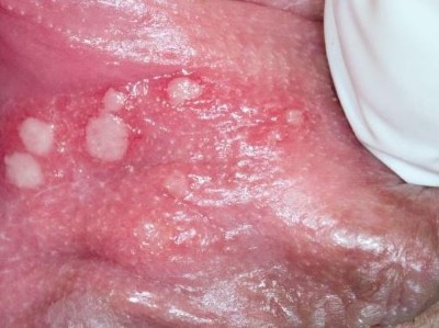 41-jährige Patientin mit Läsionen eines Herpes genitalis an der Vulva