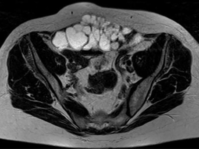 CT bei endometrioidem Karzinom