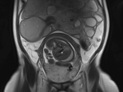 MRT bei schwangerer Patientin mit akutem Abdomen