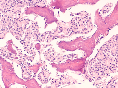 Bone metastasis in prostate cancer