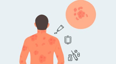 Kutane T-Zell-Lymphome im Fokus