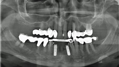 Orthopantomogramm: Postoperative Situation der Implantate 32, 42; Perforation der lingualen Kompakta an 32