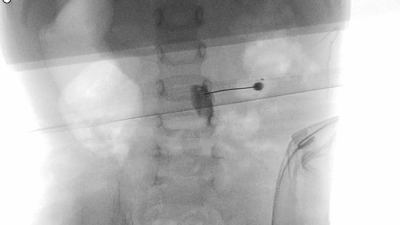 Image from case study_Scan of toddler’s spine to position the needle for a lumbar sympathetic block to treat complex regional pain syndrome