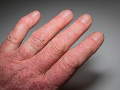 Psoriasis an der Hand