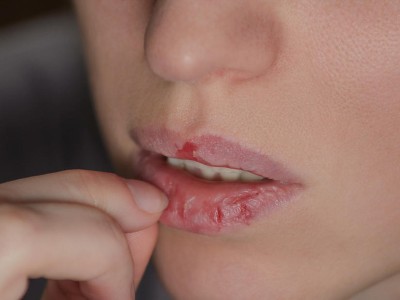 Person zupft an einer wunden Lippe