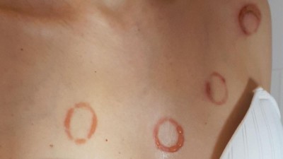 Ringförmige Blasen in Dekolleté einer Frau