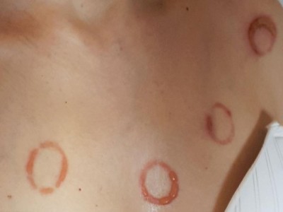 Ringförmige Blasen in Dekolleté einer Frau