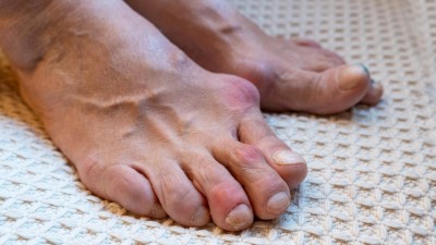 Rheumatoide Arthritis in den Füßen