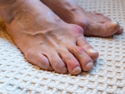 Rheumatoide Arthritis in den Füßen