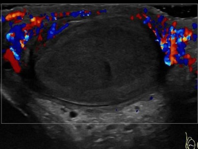 Sonographischer Befund bei Hodentorsion 