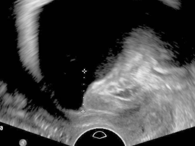 rotatorischer Descensus urethrae mit einem Meatus urethrae internus