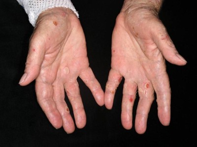 Bullöses Pemphigoid unter Immuncheckpoint-Inhibitor-Therapie