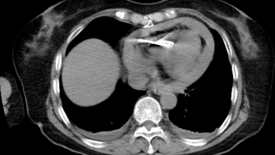 Chest CT scan showing high density shadow in the right ventricle