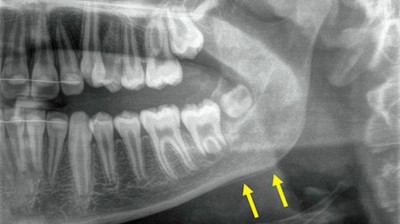 Orthopantomogramm eines Unterkiefers mit zwei gelben Pfeilen: Doppelkontur im Bereich des äußeren Kieferwinkels als Ausdruck einer periostalen Knochenapposition, milchglasartige Darstellung des linken aufsteigenden Unterkieferastes
