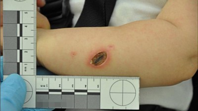 Brandverletzung am Arm des Jungen