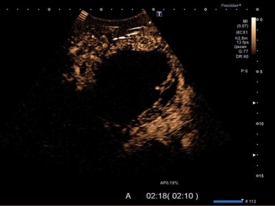 Solid-pseudopapilläre Neoplasie des Pankreas im CEUS