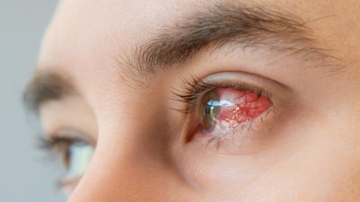 gerötetes, entzündetes Auge