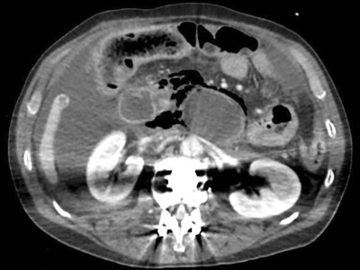 Dünndarmileus, retroperitoneale freie Luft und Aszites im CT