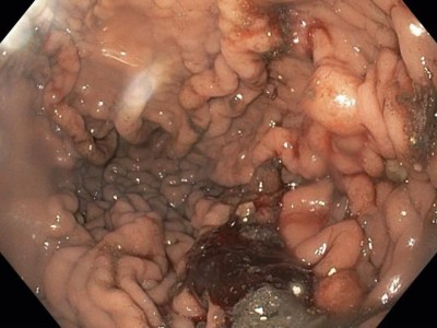 Hypertrophe, teils pseudopolypös anmutende Schleimhautfalten, mit Koagel, Sickerblutung und Hämatin