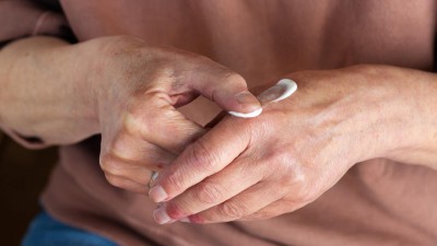 Frau cremt gereizte Hände ein